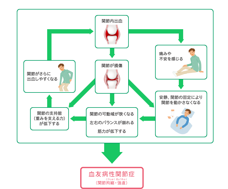関節内出血　関節が損傷　関節の可動域が狭くなる　左右のバランスが崩れる　筋力が低下する　関節の可動域が狭くなる　左右のバランスが崩れる　筋力が低下する　関節がさらに出血しやすくなる　関節がさらに出血しやすくなる　安静、関節の固定により関節を動かさなくなる
