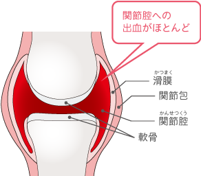 関節腔への出血がほとんど