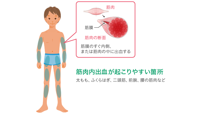筋肉内出血