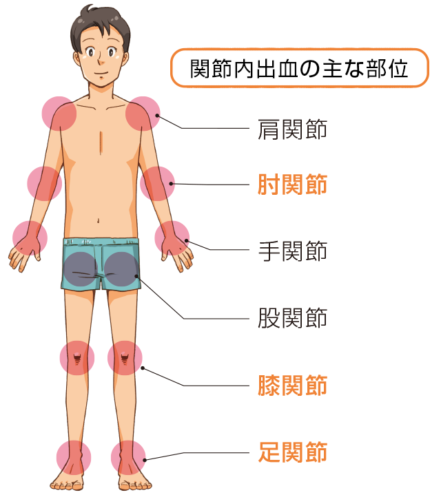 関節内出血