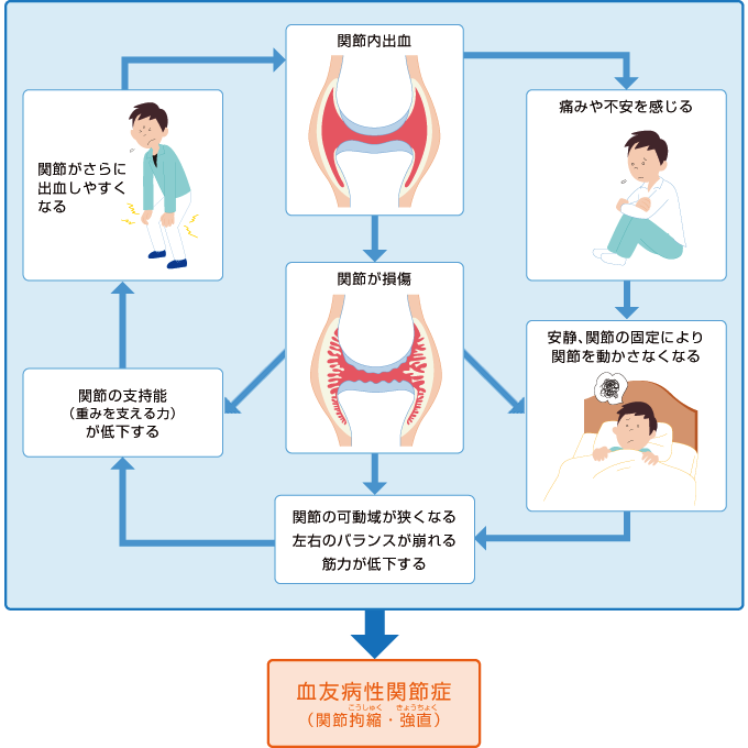 血友病性関節症