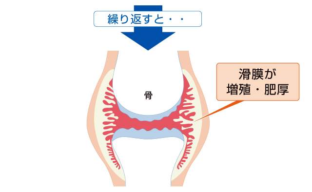 慢性滑膜炎